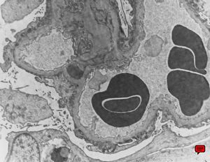 F,70y. | nephrotic syndrome: minimal changes - fusion of pedicles F,70y. | nephrotic syndrome: minimal changes - fusion of pedicles